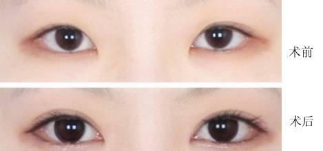 开眼角手术会减轻细纹吗,开眼角会让人显得更成熟吗