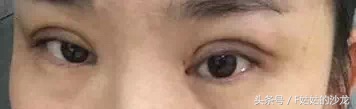 纳米无痕双眼皮的线有点红,纳米无痕双眼皮操作全过程
