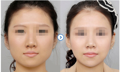 鼻子整形保质期多久,整形维护期大概是多久