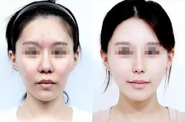 鼻子整形保质期多久,整形维护期大概是多久