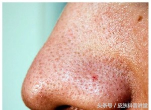 皮肤科鼻子毛孔粗大黑头怎么解决,黑头毛孔粗大出油皮肤科解决方法