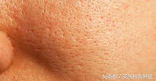 皮肤科鼻子毛孔粗大黑头怎么解决,黑头毛孔粗大出油皮肤科解决方法
