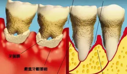 牙结石萎缩的牙龈还会恢复么,牙龈萎缩牙缝变大可以恢复吗