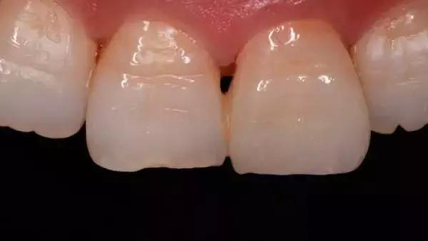 牙套黑三角要不要片切,戴牙套会出现黑三角后怎么恢复