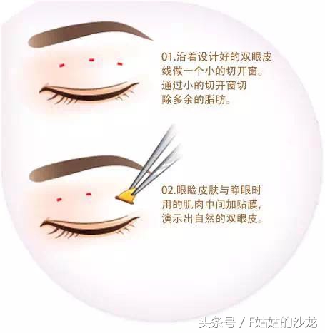 纳米无痕双眼皮的线有点红,纳米无痕双眼皮操作全过程