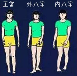 防止o型腿吃什么,如何防止o型腿越来越严重