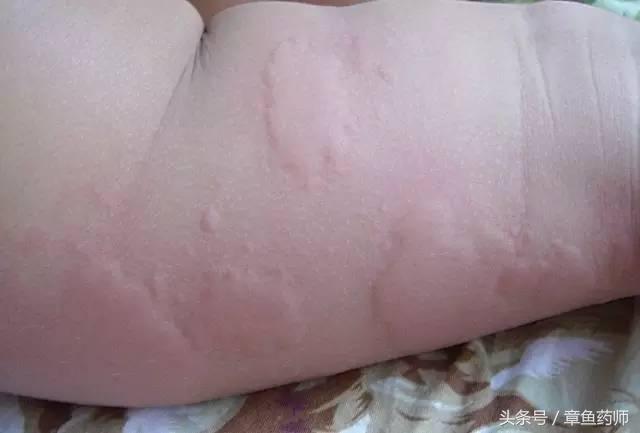 身上长脂肪疙瘩是怎么回事,身上皮下长疙瘩是怎么回事