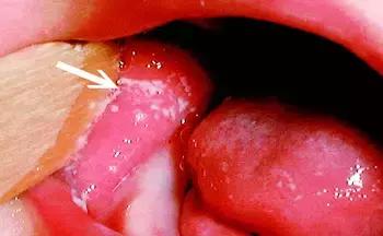 鹅鹅鹅鹅口疮,你需要知道这些