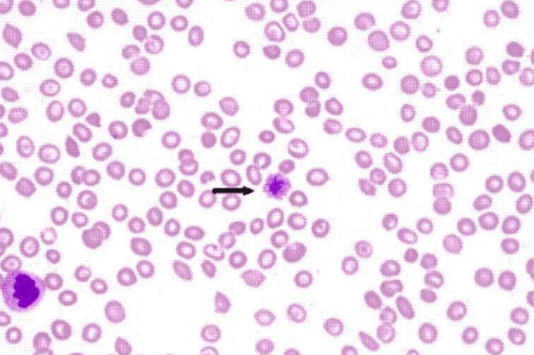 服用盐酸厄洛替尼片饮食禁忌 (吃厄洛替尼片有什么副作用)