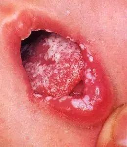 鹅鹅鹅鹅口疮,你需要知道这些