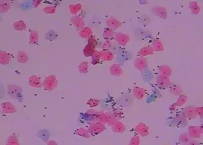 鹅鹅鹅鹅口疮,你需要知道这些