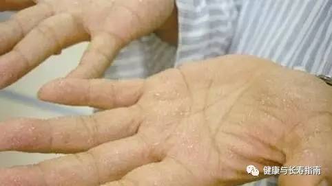 儿童手上起水泡痒脱皮用什么药膏,脚底起小水泡又痒又脱皮反反复复