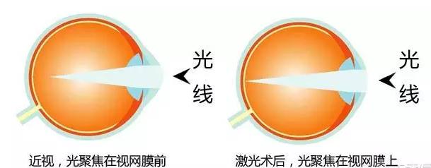 激光视力矫正手术后会再次近视吗,激光矫正近视多少岁可以矫正