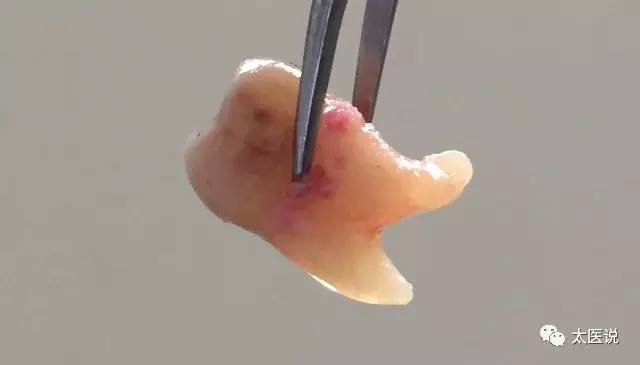 蛀牙牙疼松动疼痛难忍能拔掉吗,蛀牙牙疼刷牙能缓解吗