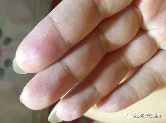 儿童手上起水泡痒脱皮用什么药膏,脚底起小水泡又痒又脱皮反反复复