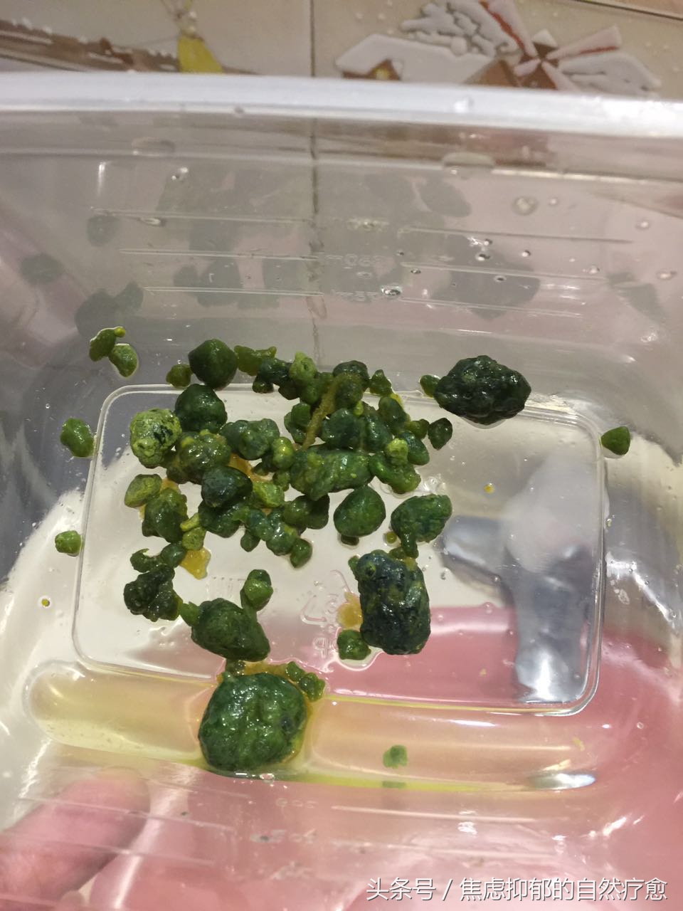 连载我如何用自然疗法战胜了自己11年的焦虑抑郁-肝胆净化原理