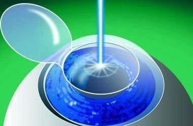 激光视力矫正手术后会再次近视吗,激光矫正近视多少岁可以矫正