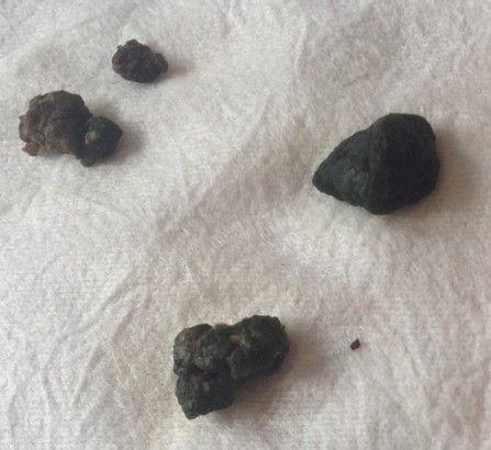 这就是肝脏结石！看完是不是觉得挺恐怖的？