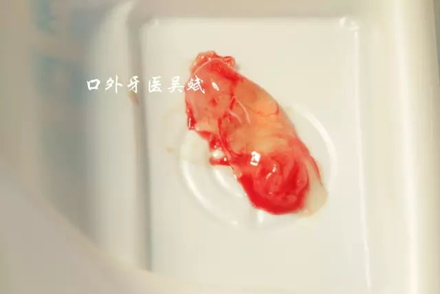 嘴里长疱怎么回事,嘴里起了好几个水泡怎么回事