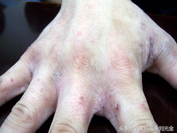 揭开谣言背后的真相,揭开麻风病村的神秘面纱