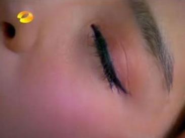 双眼皮“留疤”要多难看多难看，如何防止，留疤如何挽回？