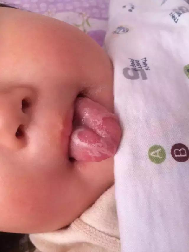 鹅鹅鹅鹅口疮,你需要知道这些