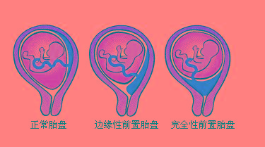 前置胎盘孕妇的注意事项,前置后壁胎盘孕妇注意事项