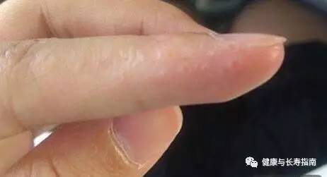 儿童手上起水泡痒脱皮用什么药膏,脚底起小水泡又痒又脱皮反反复复