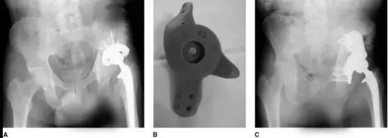 髋臼底严重骨缺损怎么翻修,髋臼骨缺损2厘米能愈合吗