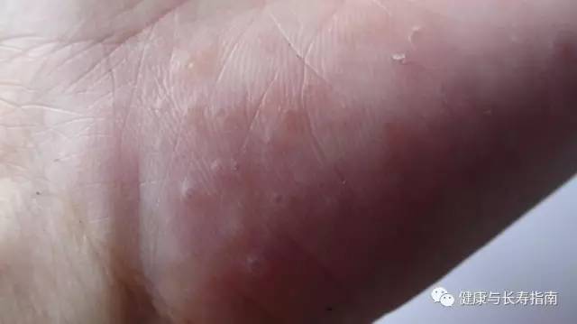 儿童手上起水泡痒脱皮用什么药膏,脚底起小水泡又痒又脱皮反反复复