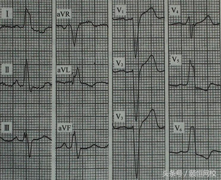 郭雅卿心电图讲解全集,郭雅卿心血管视频课