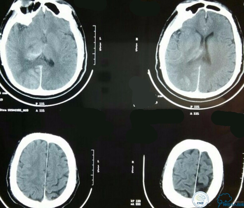 一例急性基底动脉尖综合征患者的支架取栓治疗