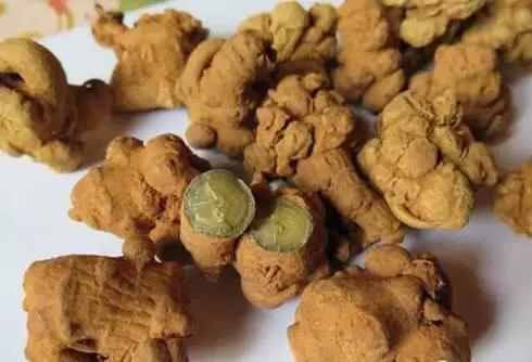 得了慢性肾炎别慌,慢性肾小球肾炎能吃三七吗