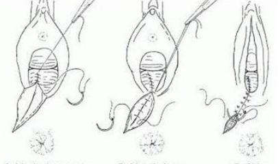 产后妈妈侧切后的护理,产后侧切缝合线多久吸收