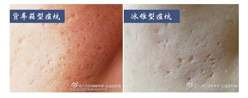 微针治痘坑涂碘伏,微针对深痘坑有效吗