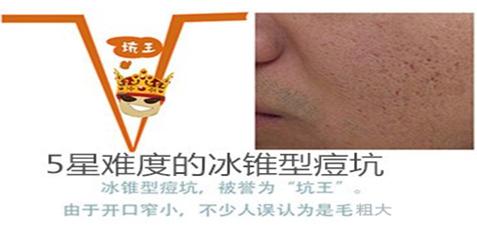 微针治痘坑涂碘伏,微针对深痘坑有效吗