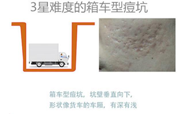 微针治痘坑涂碘伏,微针对深痘坑有效吗