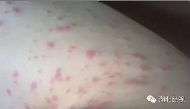 全身发痒是新冠吗怎么治疗,得新冠全身痒