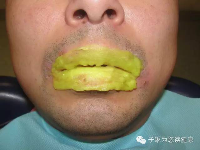 喝酒后嘴唇起皮裂口是怎么回事,嘴唇裂口起皮是什么原因