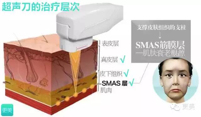 青春定格?4D埋线?音波拉皮?别晕,面部提升就那老三样