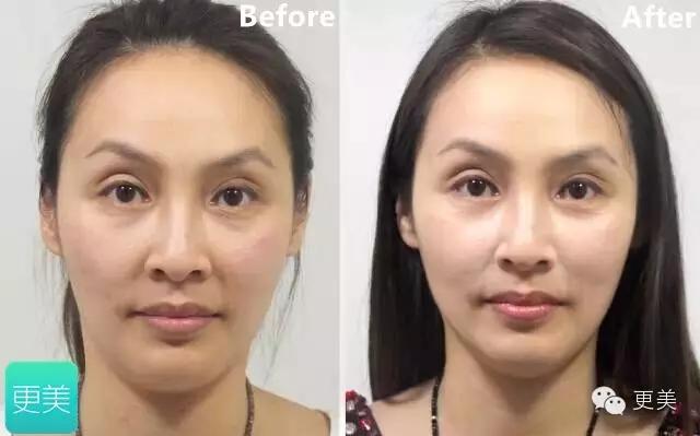 青春定格?4D埋线?音波拉皮?别晕,面部提升就那老三样