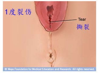 第67课:会阴侧切与撕裂