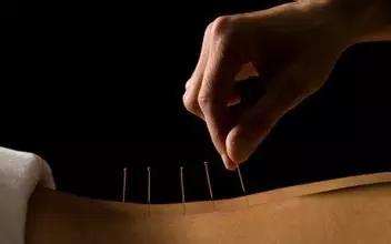 针灸是扎针跟艾灸吗,针灸如果针灸不对穴位会不会死