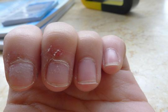 手指有刀枪刺是缺少维生素吗,手指爱起刀枪刺是什么原因