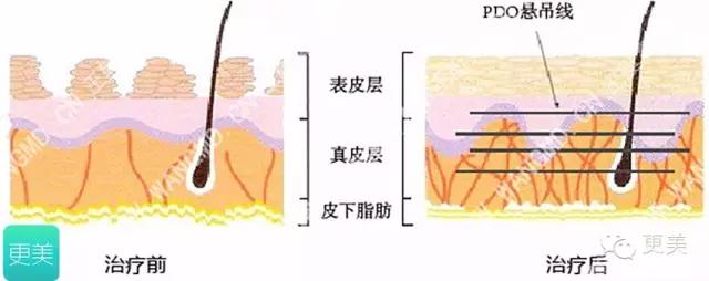 青春定格?4D埋线?音波拉皮?别晕,面部提升就那老三样