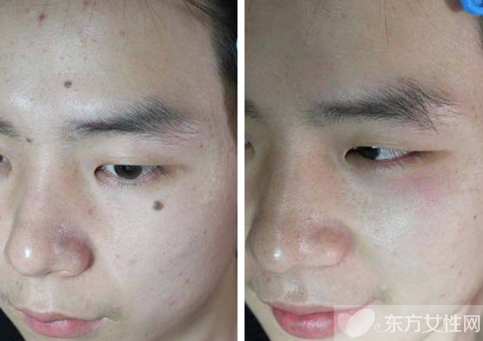 点痣脱痂有红印需要注意什么,点痣膏点完痣需要注意什么