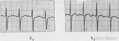郭雅卿心电图讲解全集,郭雅卿心血管视频课