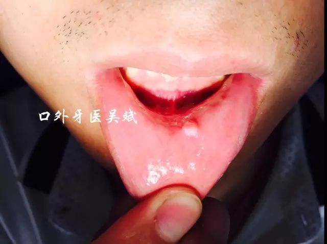 嘴里长疱怎么回事,嘴里起了好几个水泡怎么回事