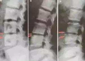 谁知道结核性胸膜炎,肺上有结核病灶就一定是肺结核吗