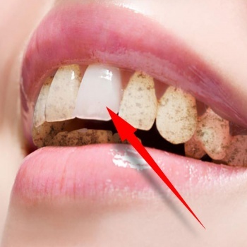 冷光美白牙齿两颗需要多少钱,冷光美白后牙齿酸疼怎么缓解